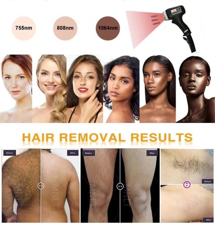 2400W Laser Power High-efficiency Diode Laser Hair Removal Instrument