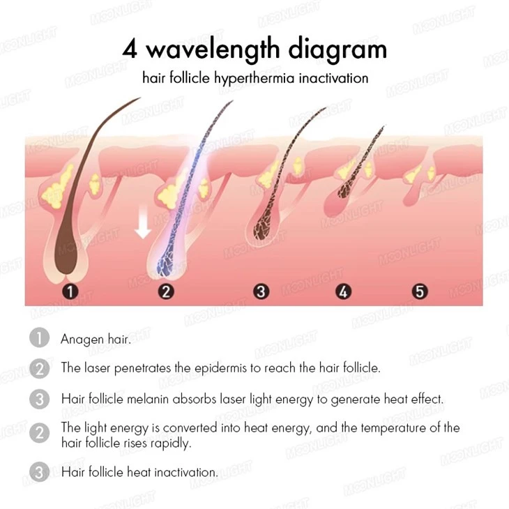 Diode Laser Hair Removal Equipment