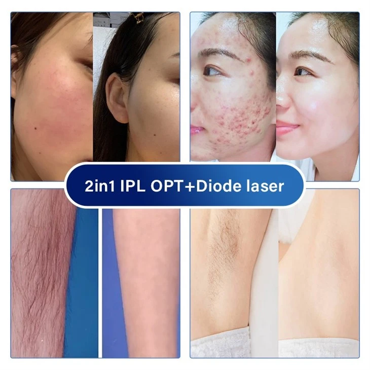 Ipl Diode Laser Hair Removal Machine