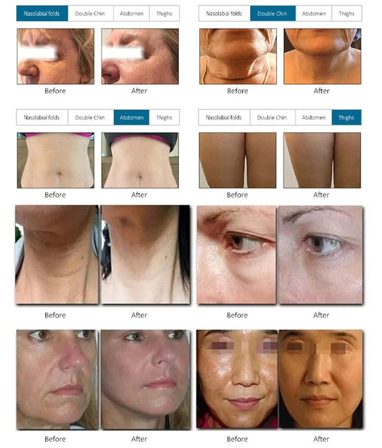 7D HIFU Machine: Your Ultimate Anti-Aging Solution