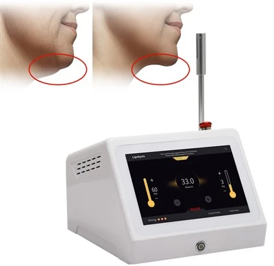 Máy làm tan mỡ y tế 3D Lipolysis Hút mỡ 1470nm 980nm Diode Laser Endolaser