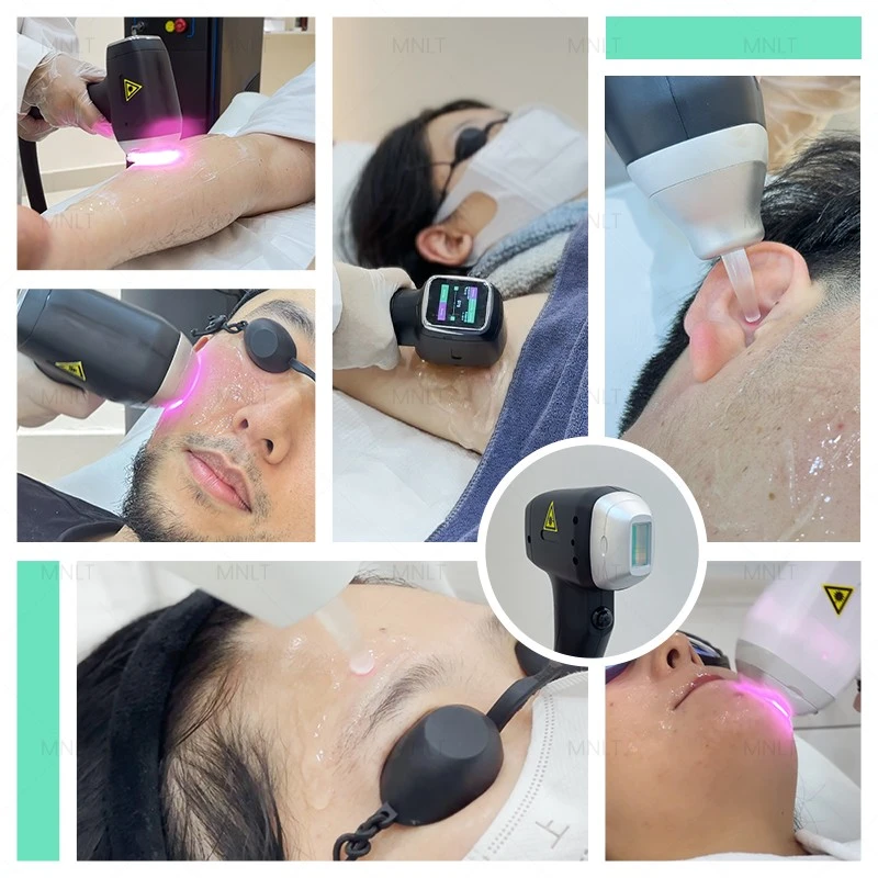 Soprono Laser Hair Removal Machine